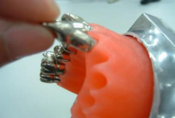 5. Insert Metal Teeth. To facilitate insertion, immerse Typodont with Wax Form in warm water.