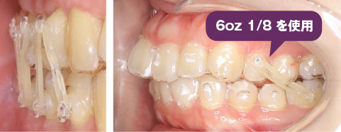 臨床写真 アライナーとの併用例