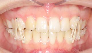 臨床写真 エラスティック